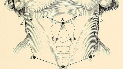 Puntos de incisión en una laringectomía