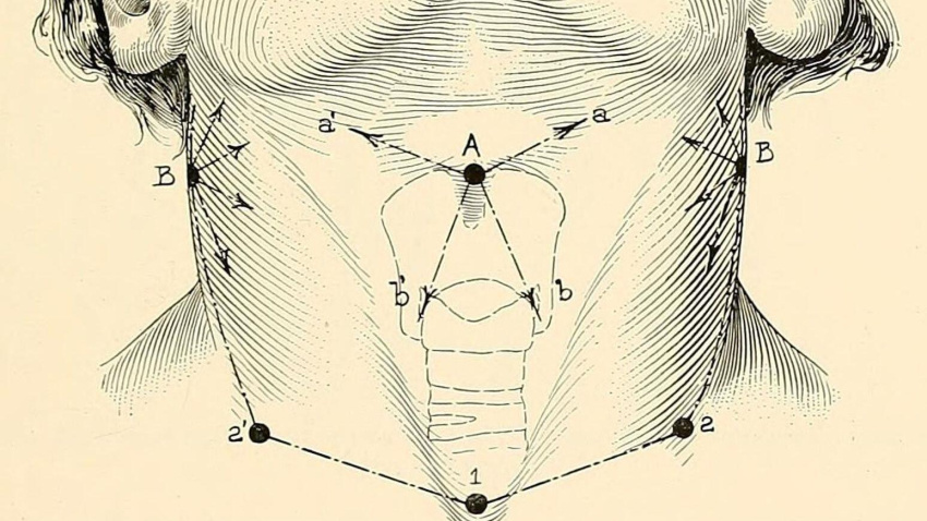 Puntos de incisión en una laringectomía