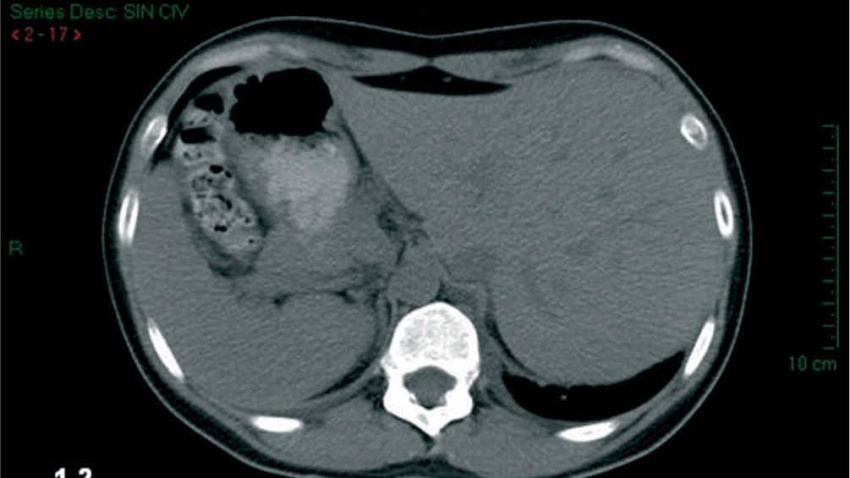 Situs inversus totalis