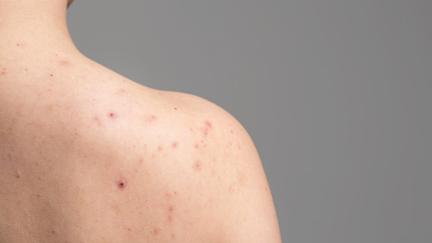 El acné no es solo cosa de adolescentes: una experta revela por qué aparece en la edad adulta y cómo tratarlo