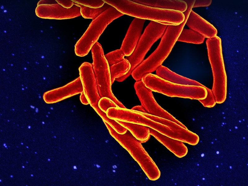 Tuberculosis