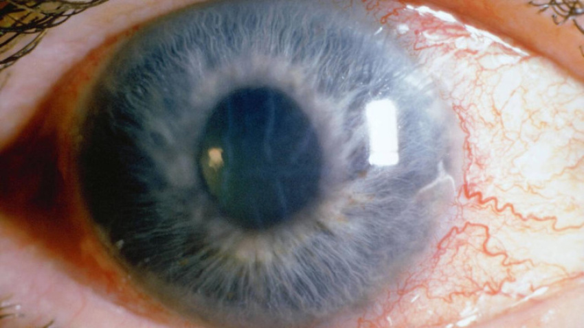 Glaucoma  " el ladrón silencioso de la vista"