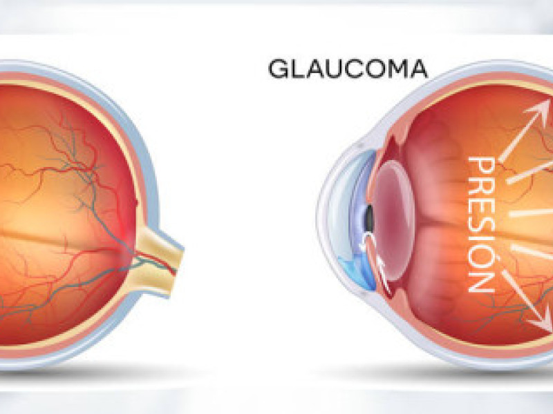 -GLAUCOMA -