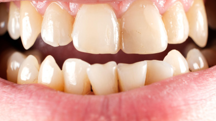 Dientes con caries y sarro