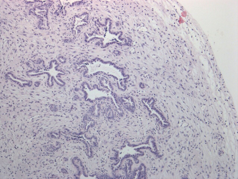 Células cancerosas de páncreas