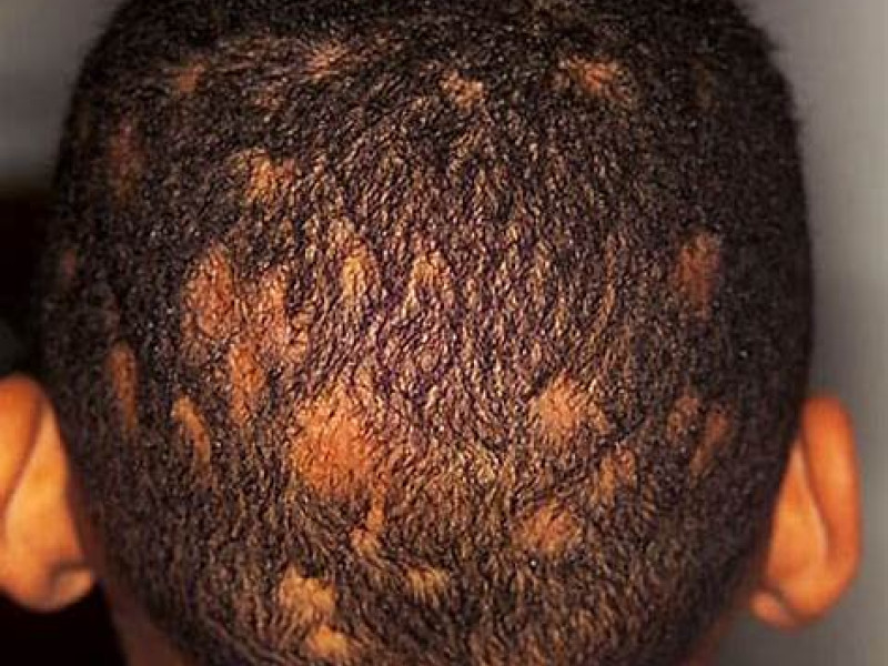 Varias lesiones por tiña