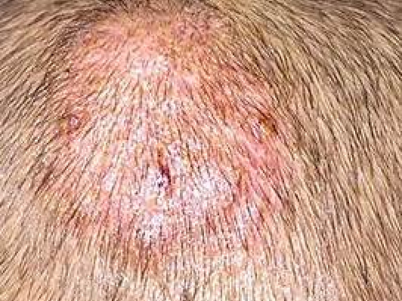 Cada  lesión por tiña puede ser distinta