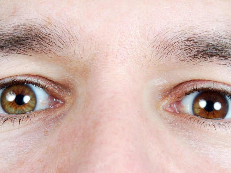 Persona con heterocromía en los ojos