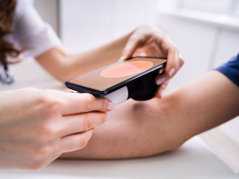 Un estudio revela que el melanoma se ha duplicado en mayores de 65 años en el sur de Sevilla