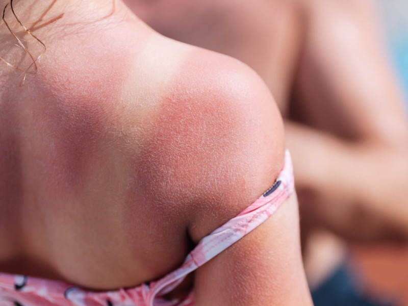 Los expertos advierten: "las quemaduras en la piel pueden causar melanomas"