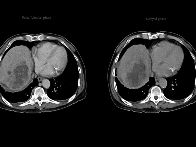El cáncer infantil está considerado una enfermedad rara