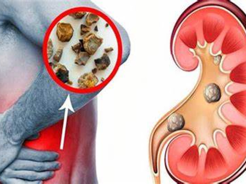 Los cálculos renales pueden surgir si los riñones están desequilibrados