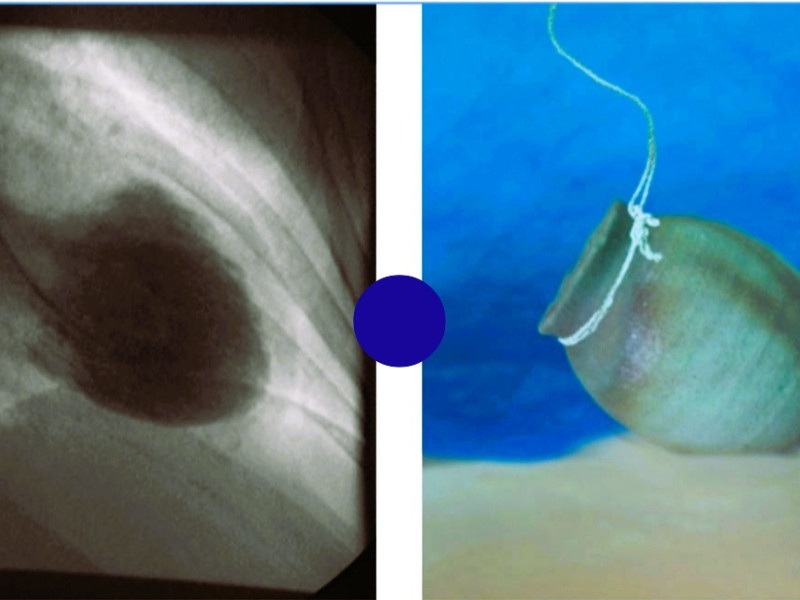 recibe su nombre por la forma que adquiere el ventrículo izquierdo del corazón durante la afección, que se asemeja a una vasija japonesa llamada "takotsubo" (trampa para pulpos).