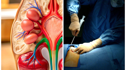 Donar un riñón a cambio de dinero: así funciona el protocolo en España para evitarlo