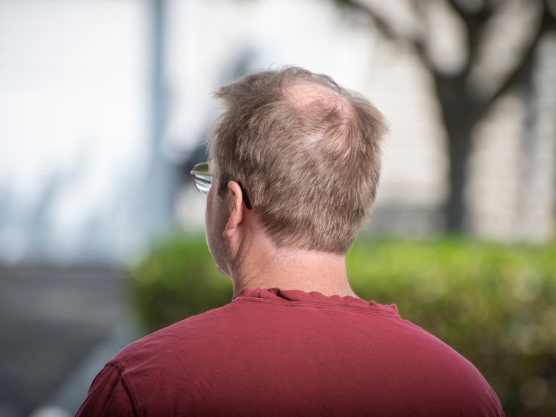 Hombre con alopecia