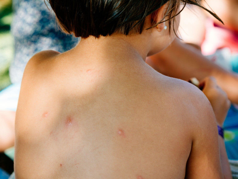 Niño con la espalda llena de picaduras