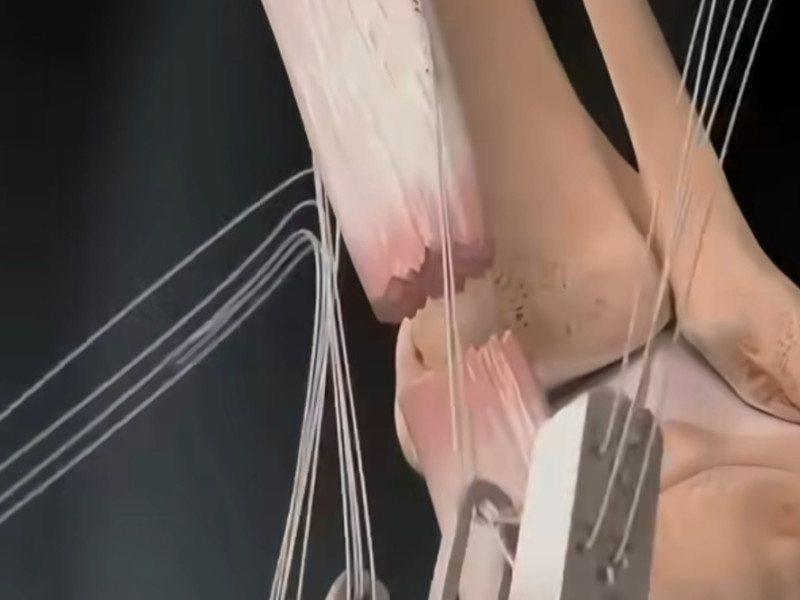 Reconstrucción virtual de la operación a la que ha sido sometido Diego San Román