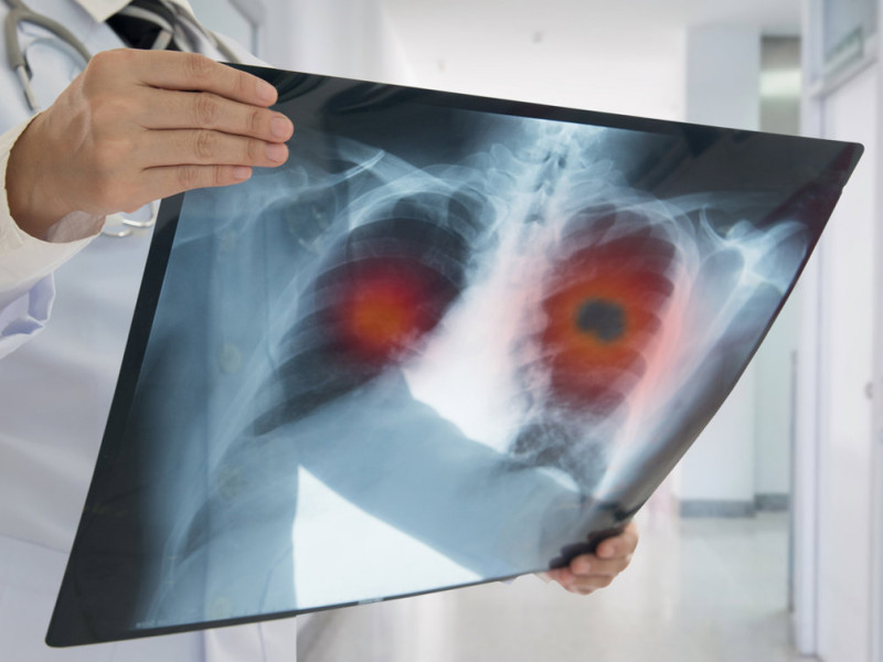 Imagen sobre una tumoración pulmonar