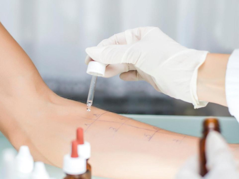 Prueba de alergia