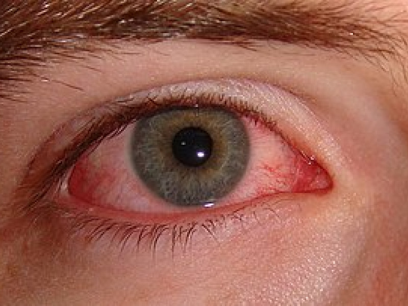 Conjuntivitis