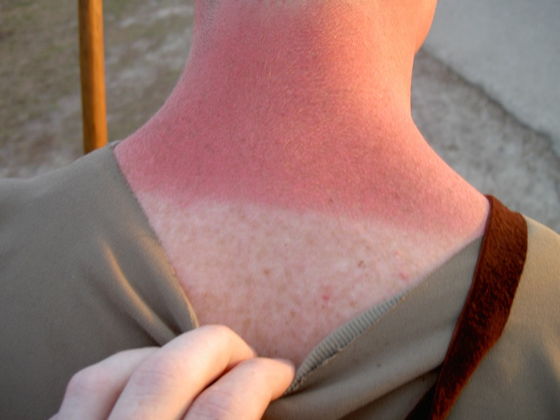 Quemaduras solares