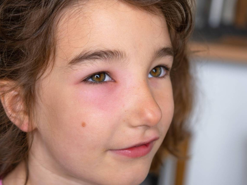Un párpado rojo e hinchado en la cara de una niña por una picadura