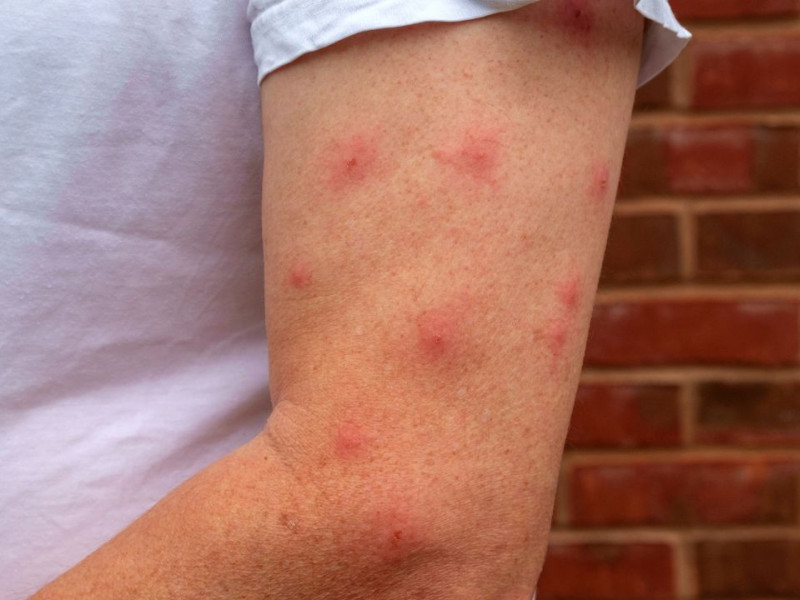 Picaduras de mosquito en el brazo