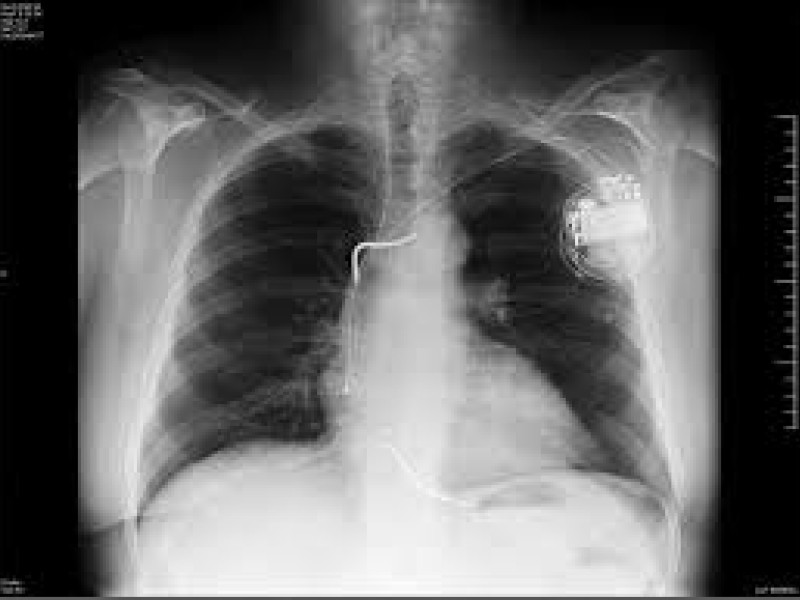 Desfibrilador automático implantable (DAI) visto a través de una radiografía