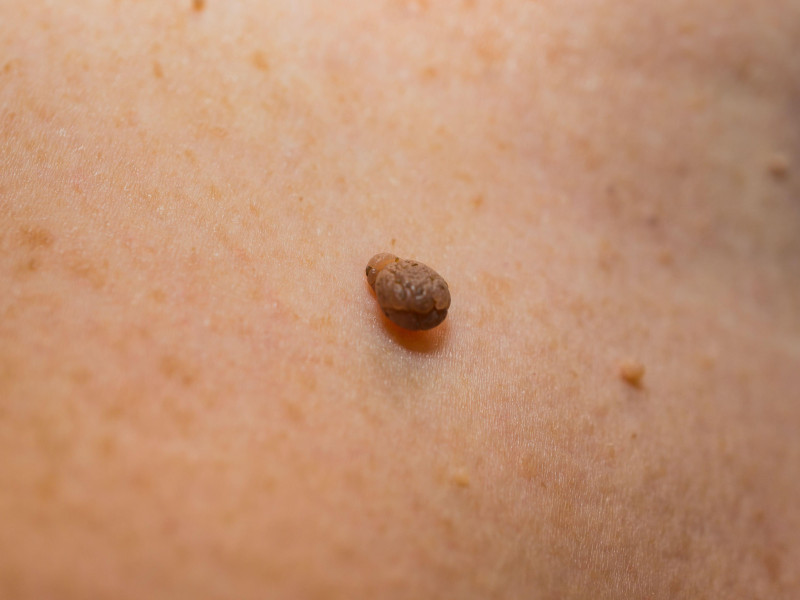 Papiloma en el cuello de una mujer