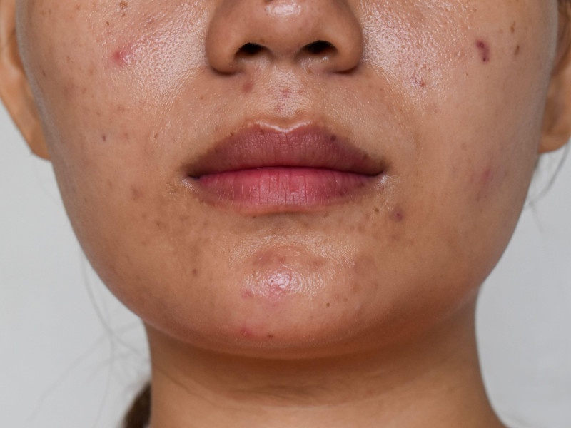 Piel facial problemática con granos, manchas oscuras y cicatrices de acné.