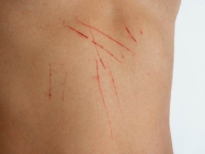 Torso humano con cicatrices