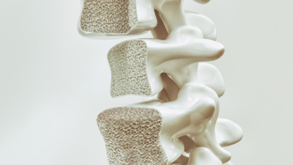Columna vertebral con osteoporosis