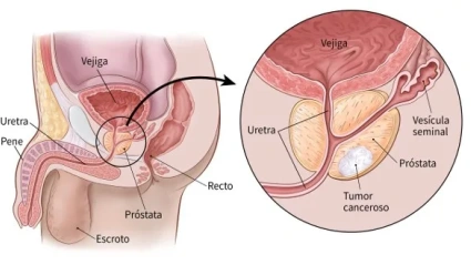 La próstata tiende a crecer con la edad.