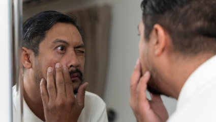Hombre examinando su ojo rojo en el espejo