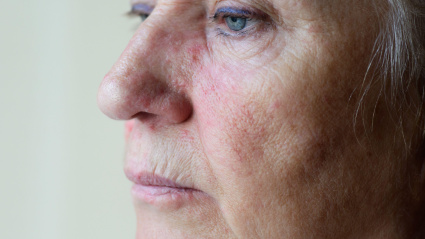 Mujer mayor con piel sensible afectada por rosácea.