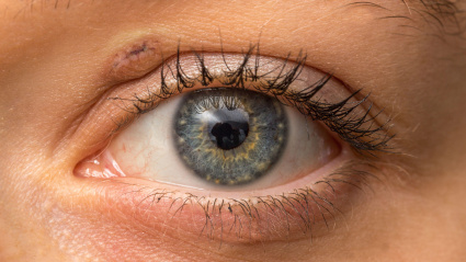 Una mujer con una cicatriz en un párpado