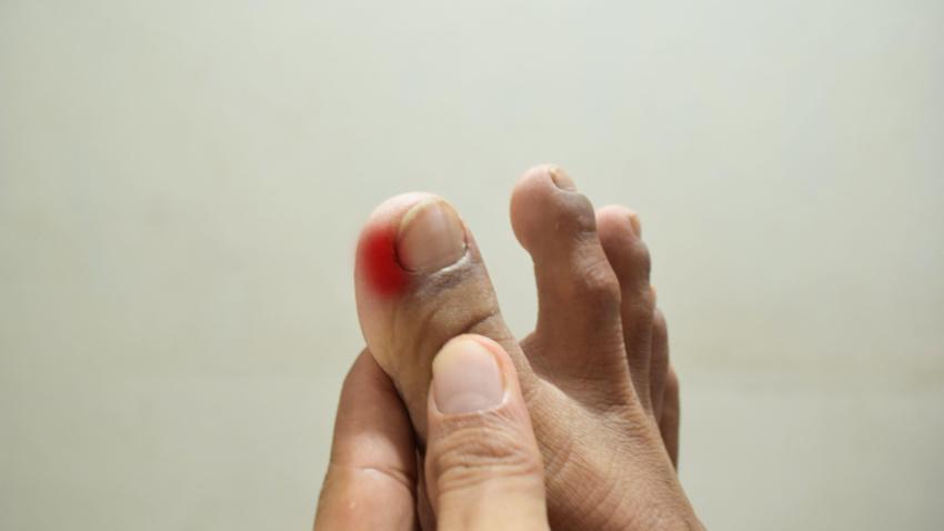 Uñas encarnadas en el pie de un hombre, dolor en el dedo gordo del pie.