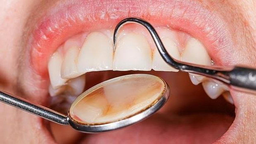 La gingivitis una de las enfermedades orales más frecuentes