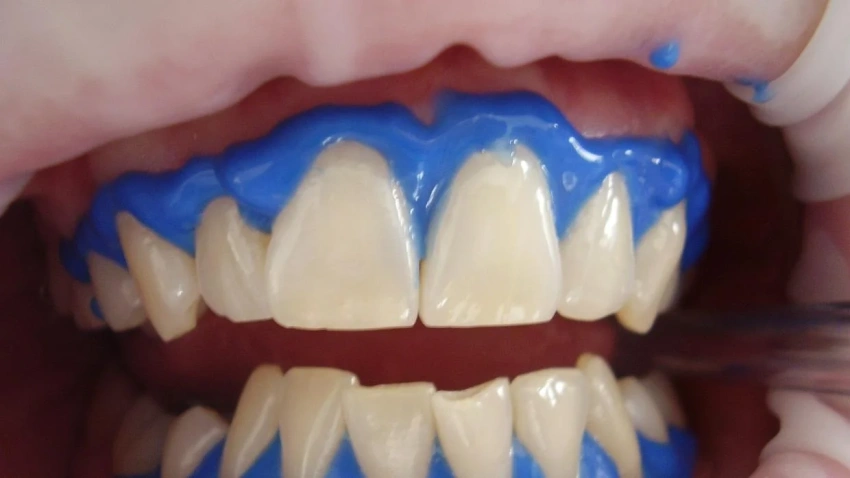 os blanqueamientos por cuenta propia son muy peligrosos