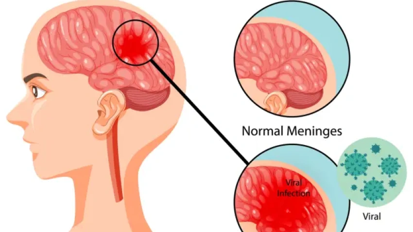 Un brote de meningitis en Reino Unido hace saltar las alarmas