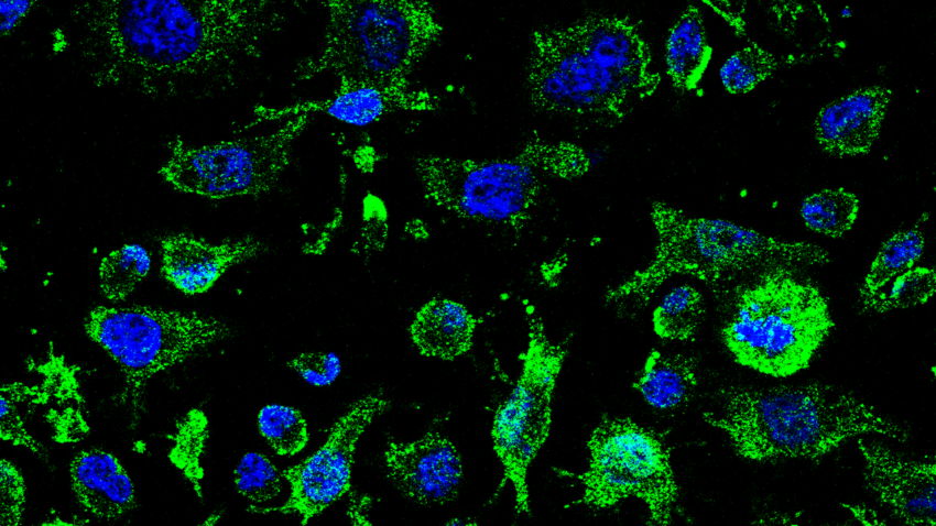 Imagen de agregados de TDP-43 (verde) fuera de los núcleos (azul) en los linfocitos de pacientes de ELA