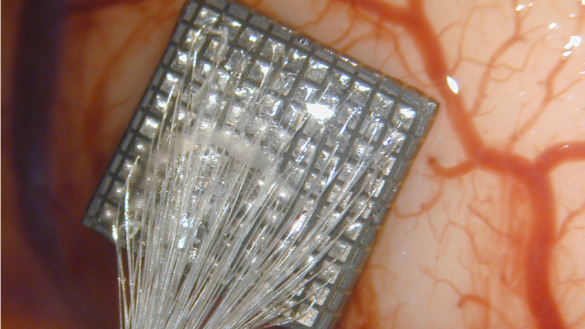 El implante en el cerebro