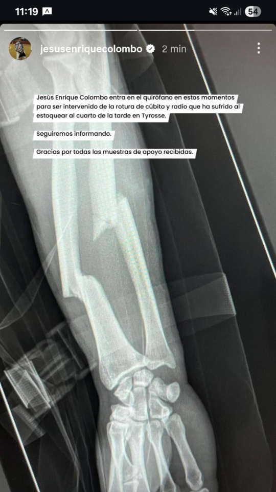 Detalle de la fractura de cúbito y radio sufrida por Colombo