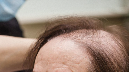 Alopecia en mujeres