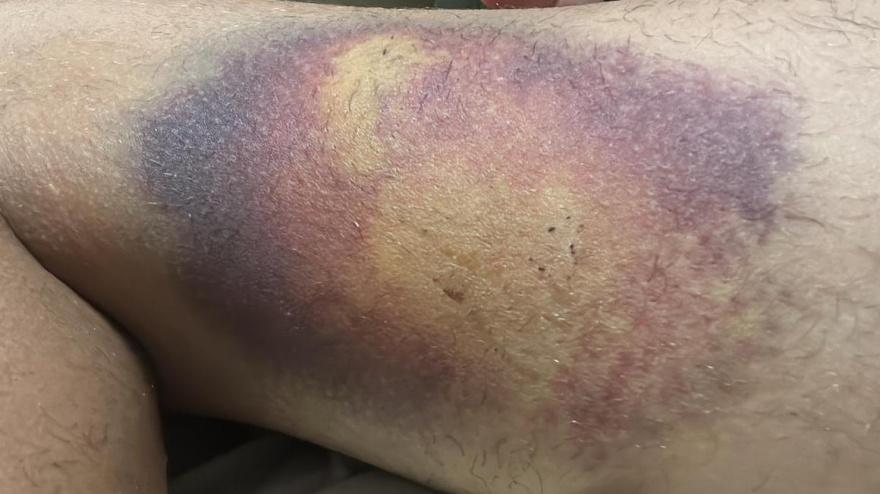 Estado de la pierna de Fran