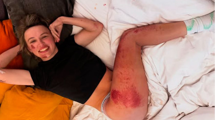 Las heridas de Katarzyna Niewiadoma