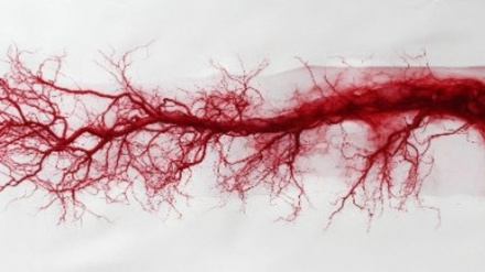 La arteritis de células gigantes afecta principalmente a arterias de gran y mediano calibre