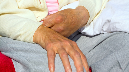 persona afectada por daño cerebral, ictus. Foto de archivo