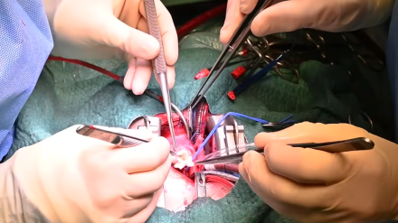 Mariami, primera bebé en España con un trasplante parcial de corazón