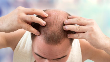 Un hombre con alopecia